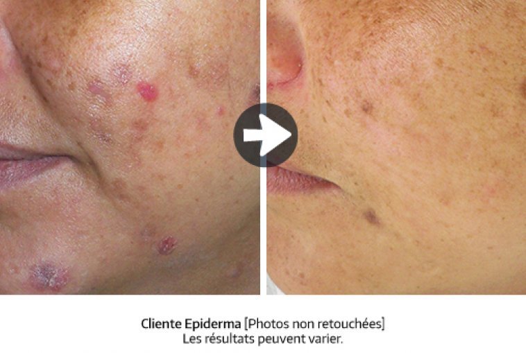 resultat_neutra-acne_peeling_fr