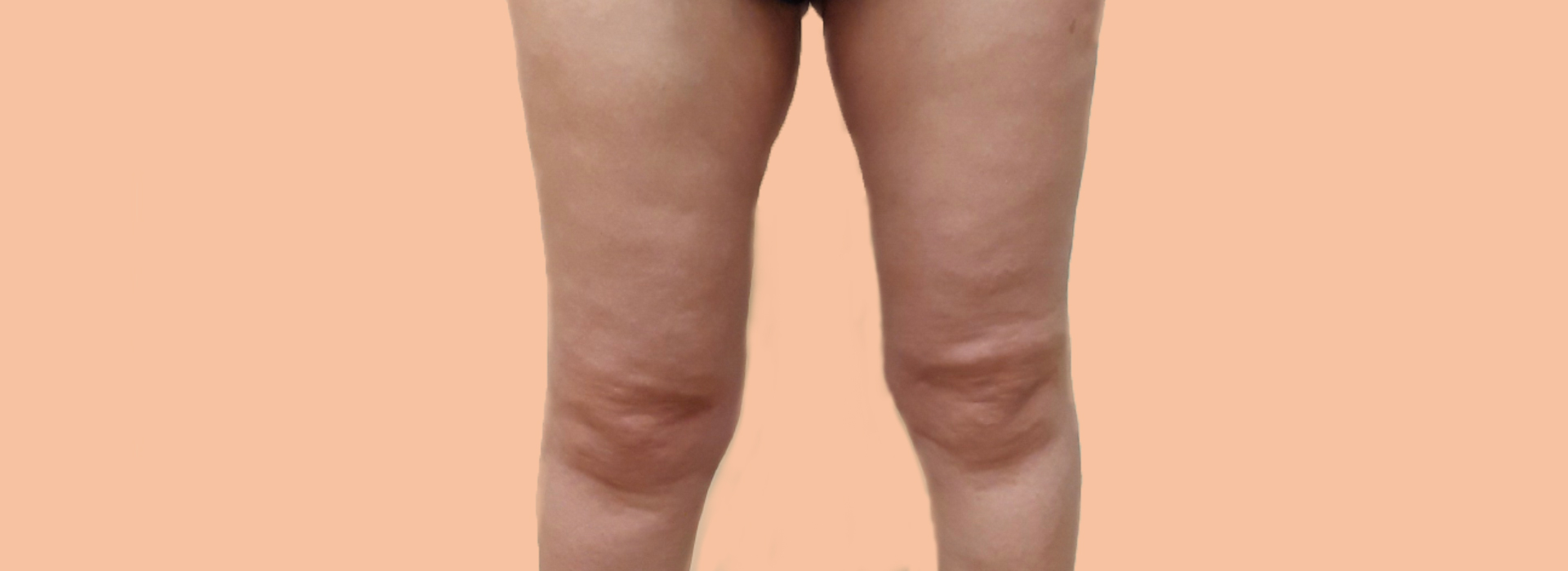 Cellulite treatment with VelaShape 3 technology