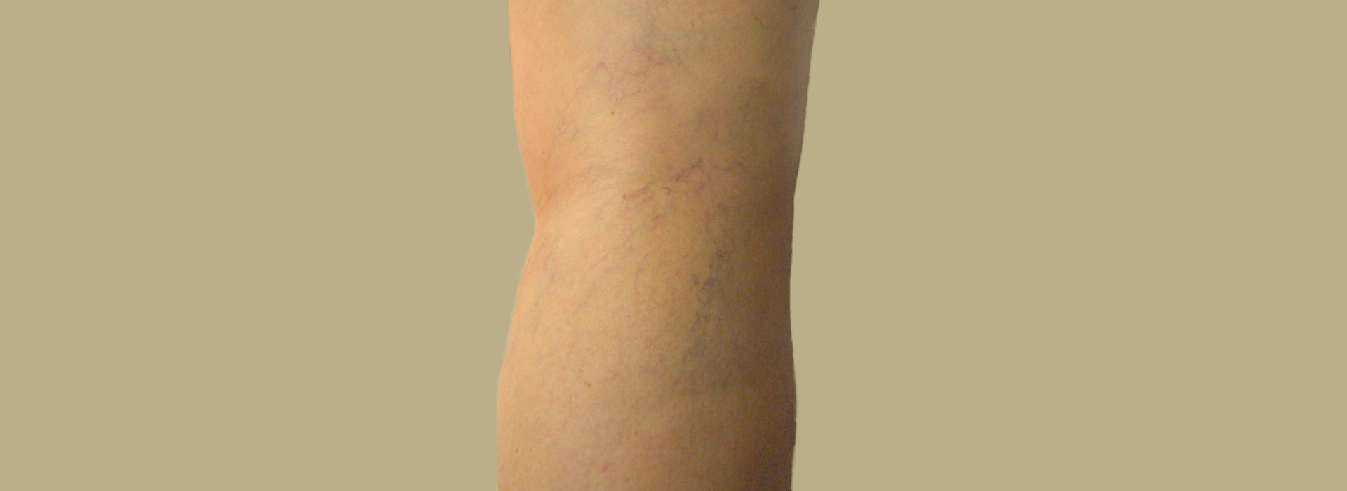 Varicose Veins: Causes, Symptoms and Treatment - Stratum Clinics