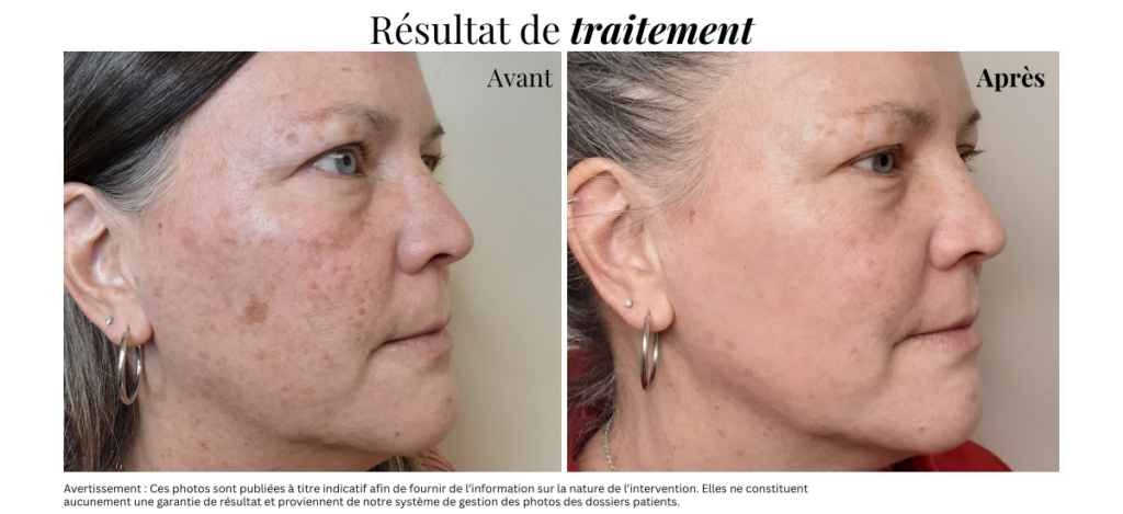 Résultat de traitement de photorajeunissement pour réduire l'apparence des taches brunes chez Epiderma