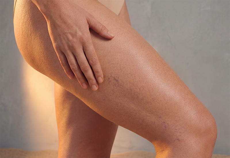 Varicose vein treatment with sclerotherapy at Epiderma to reduce spider veins and enhance leg circulation.