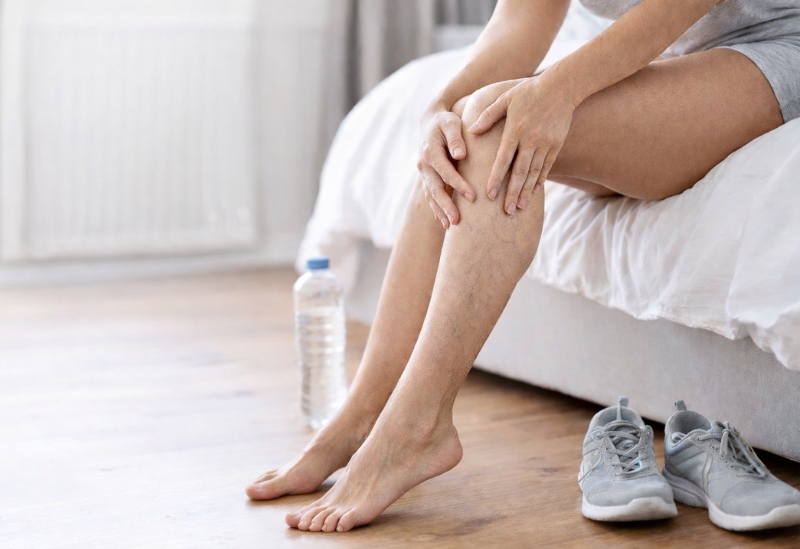 Comment prévenir l’apparition des varicosités sur les jambes? 