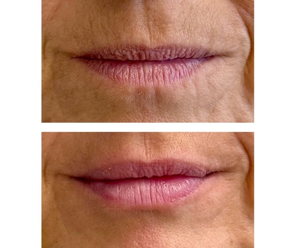 Avant et après comblement des lèvres avec agent de comblement à l’acide hyaluroniqueRésultat avant et après injections d’acide hyaluronique pour augmenter le volume des lèvres
