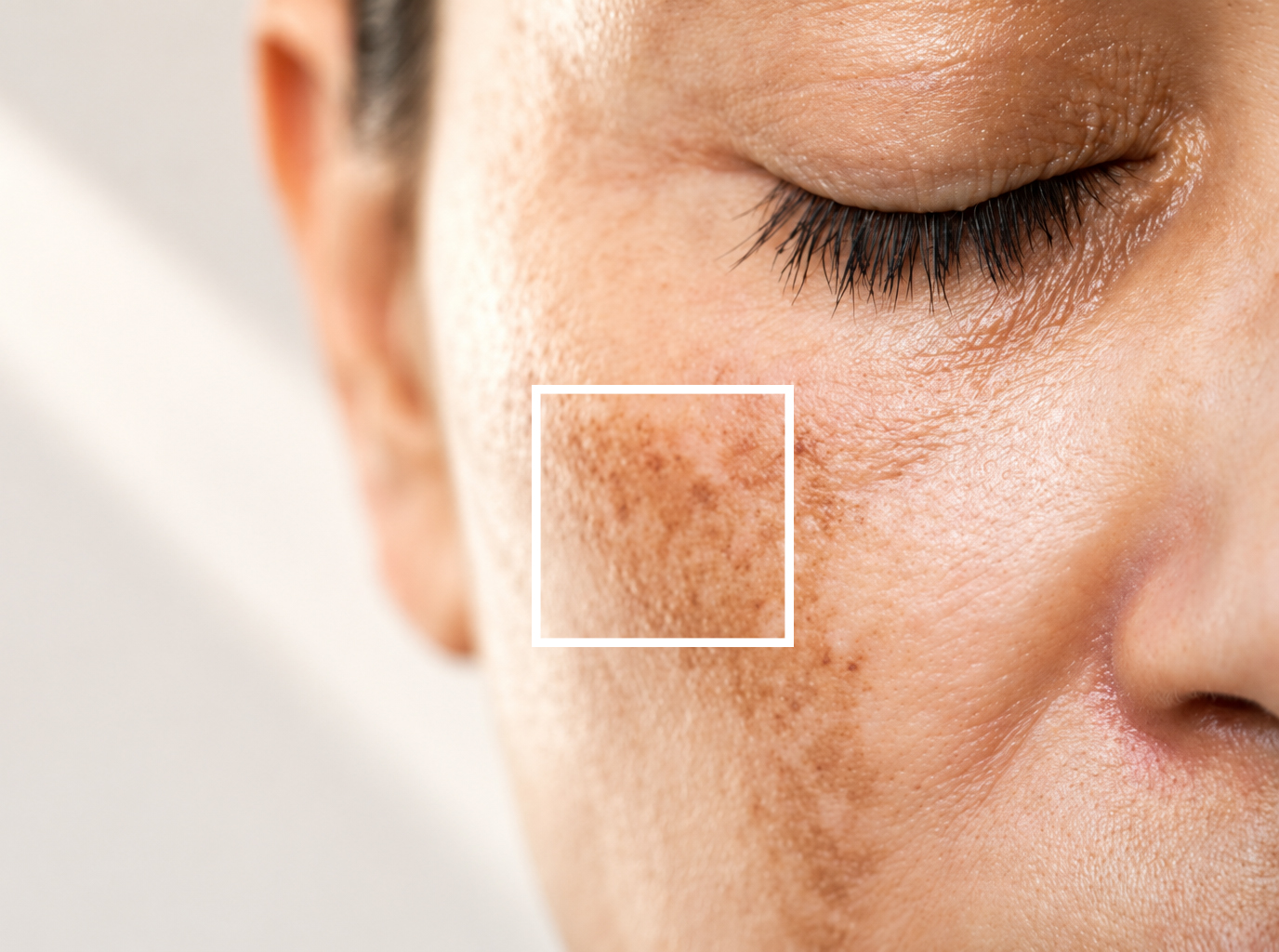 Pigmentation Spots: Why They Appear and How to Treat Them